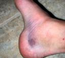 Bruised Foot