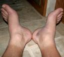 Swollen ankle and foot